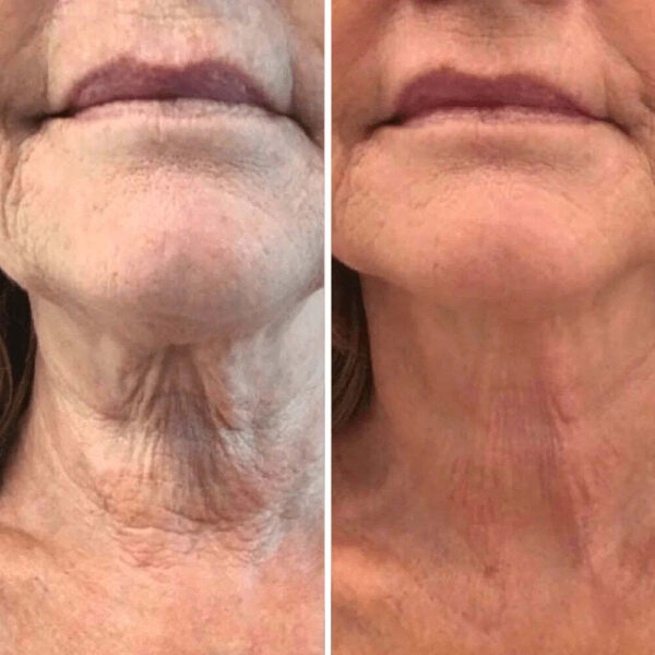REVOX™ Lifting Neck Cream