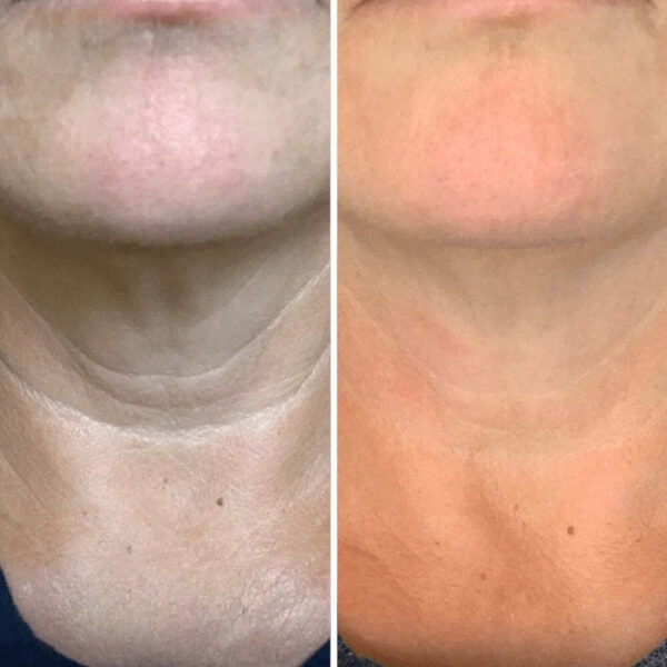 REVOX™ Lifting Neck Cream
