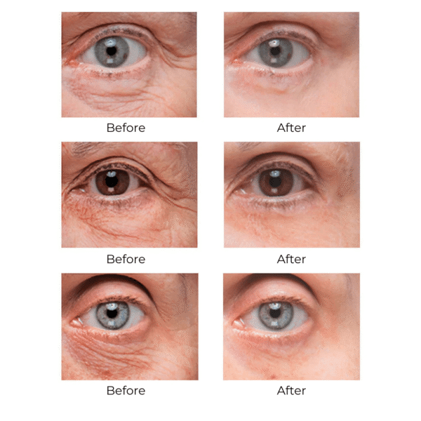 REVOX™ BrightUp - Eliminates eye bags & wrinkles