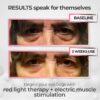Revox® 2-in-1 Red Light Therapy + EMS To Erase Eye Bags