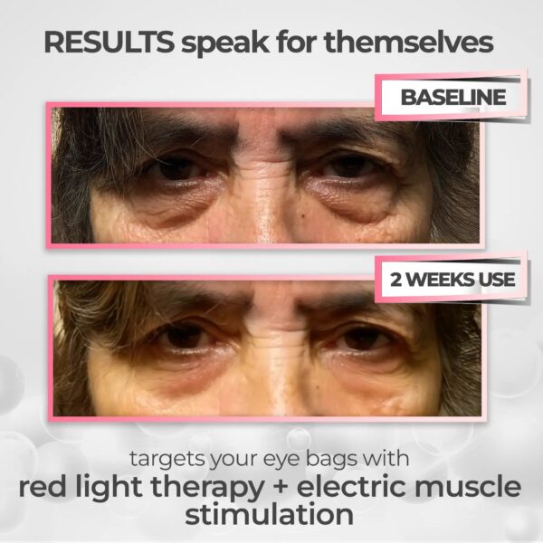Revox® 2-in-1 Red Light Therapy + EMS To Erase Eye Bags