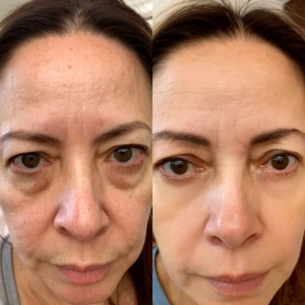 Revox® 2-in-1 Red Light Therapy + EMS To Erase Eye Bags